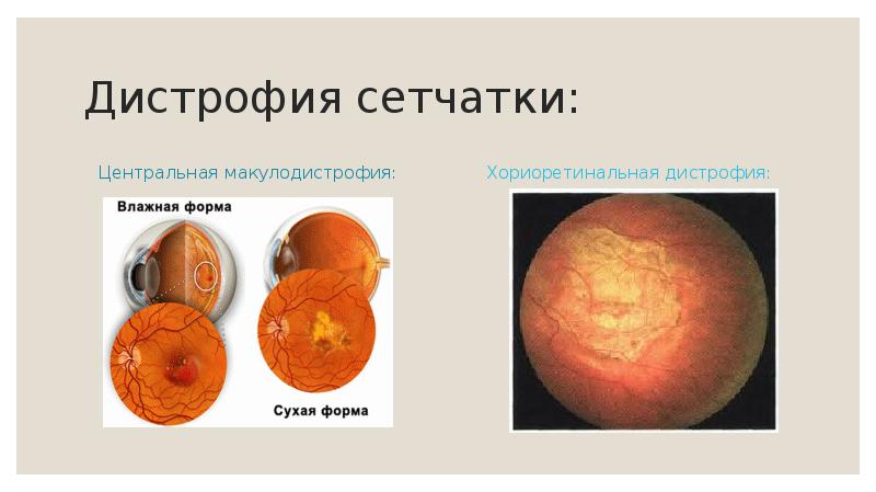 Дистрофия сетчатки глаза операции. Центральная дегенерация сетчатки рубцовая форма. Центральная приобретенная дистрофия. Виды центральных дистрофий сетчатки.