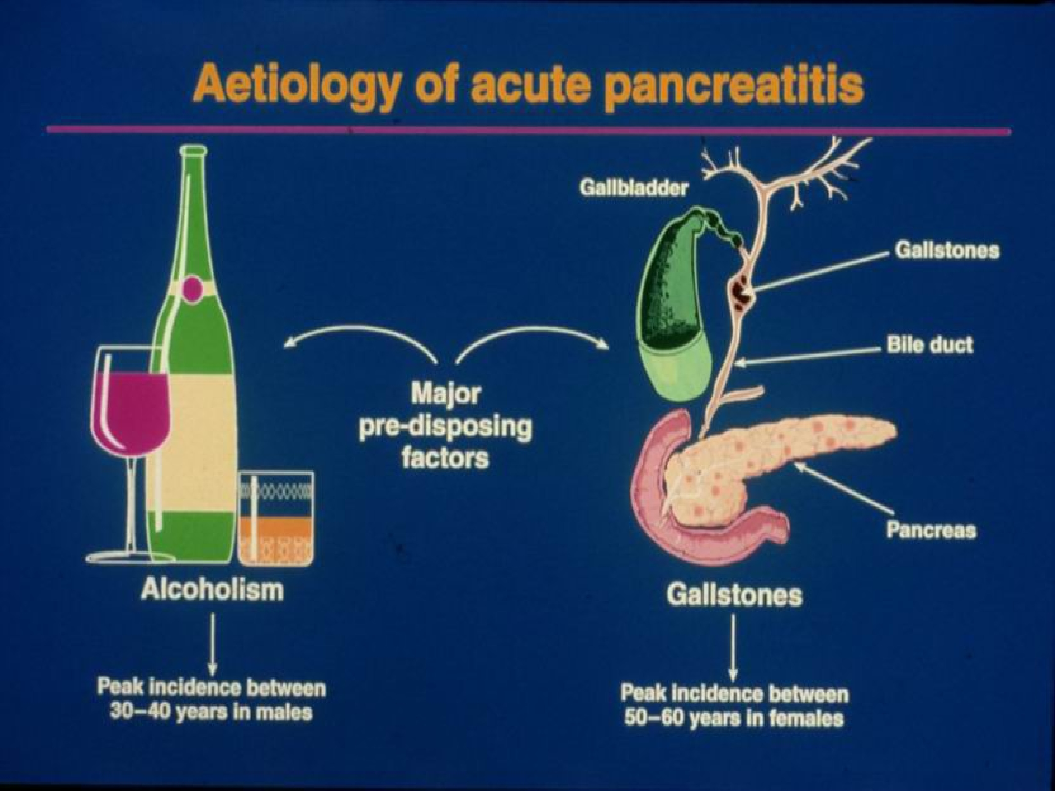Панкреатит лекция. Хронический панкреатит этиология. Схема патогенеза панкреатита. Панкреатит этиология и патогенез. Патогенез хронического алкогольного панкреатита.
