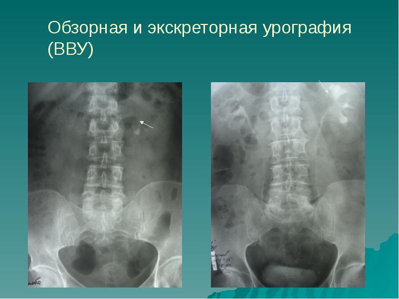 На качестве изображения мочевых путей при экскреторной урографии отражается