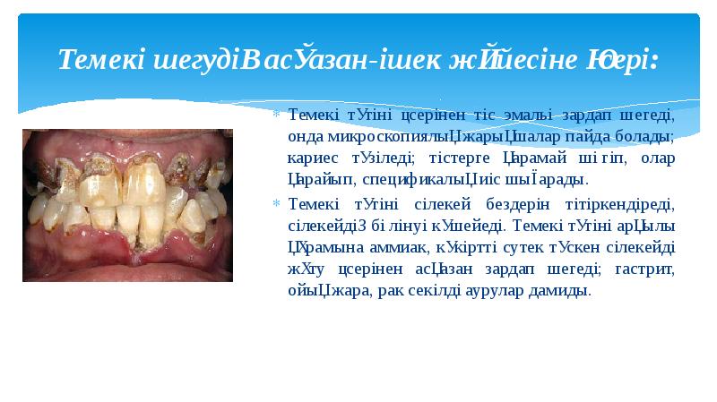 Темекі шегудің асқазан-ішек жүйесіне әсері:
Темекі түтіні әсерінен тіс эмальі зардап Темекі шегудің асқазан-ішек жүйесіне әсері:
Темекі түтіні әсерінен тіс эмальі зардап