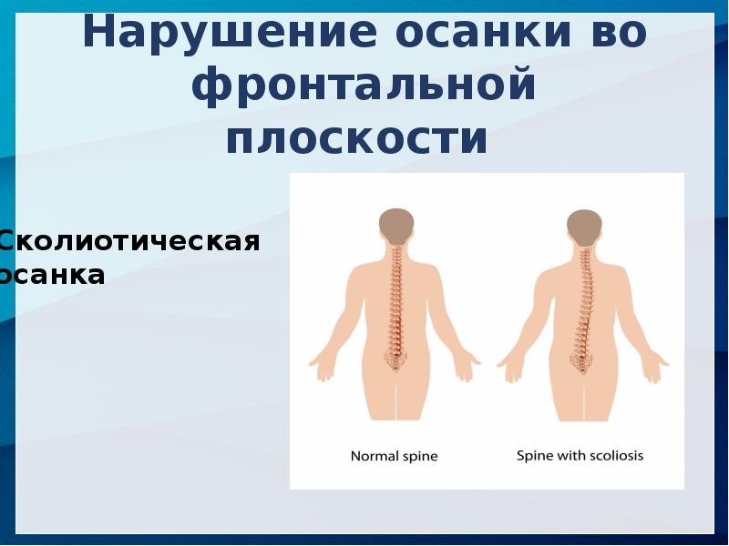 Фронтальная плоскость позвоночника. Фронтальная плоскость осанки. Нарушение осанки. Нарушение осанки во фронтальной плоскости у детей. Отклонение позвоночника во фронтальной плоскости.