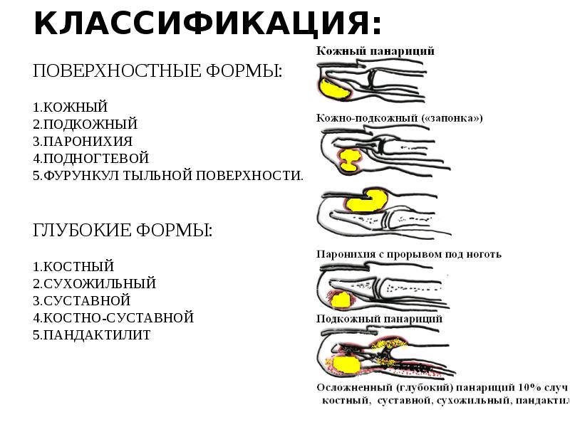 Панариций ногтя на руке фото Панариций