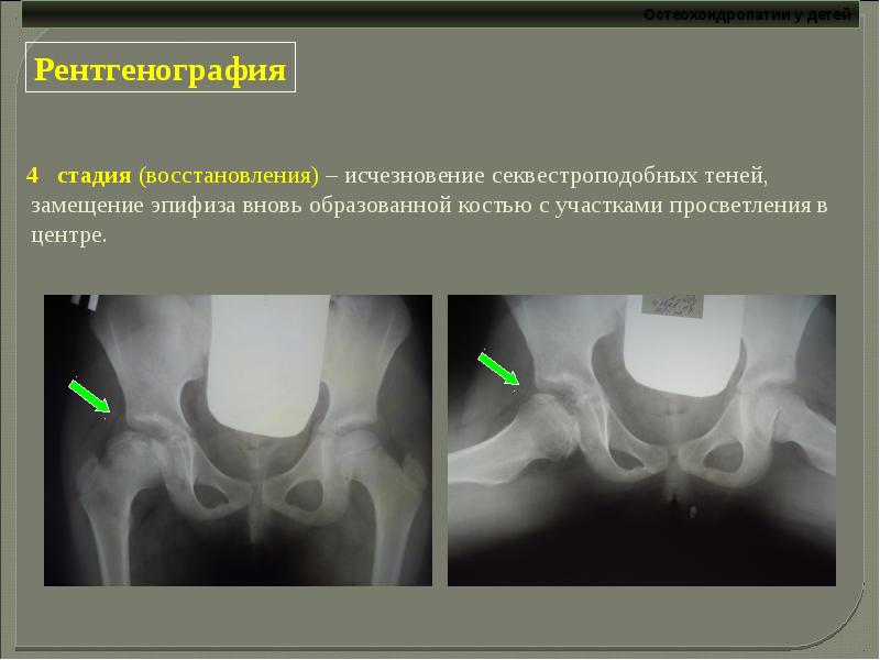 Остеохондропатии у детей презентация