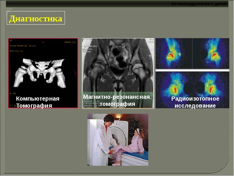 Остеохондропатии у детей презентация