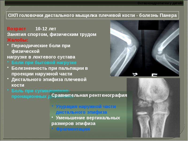 Остеохондропатии у детей презентация