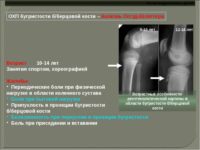 Остеохондропатии у детей презентация