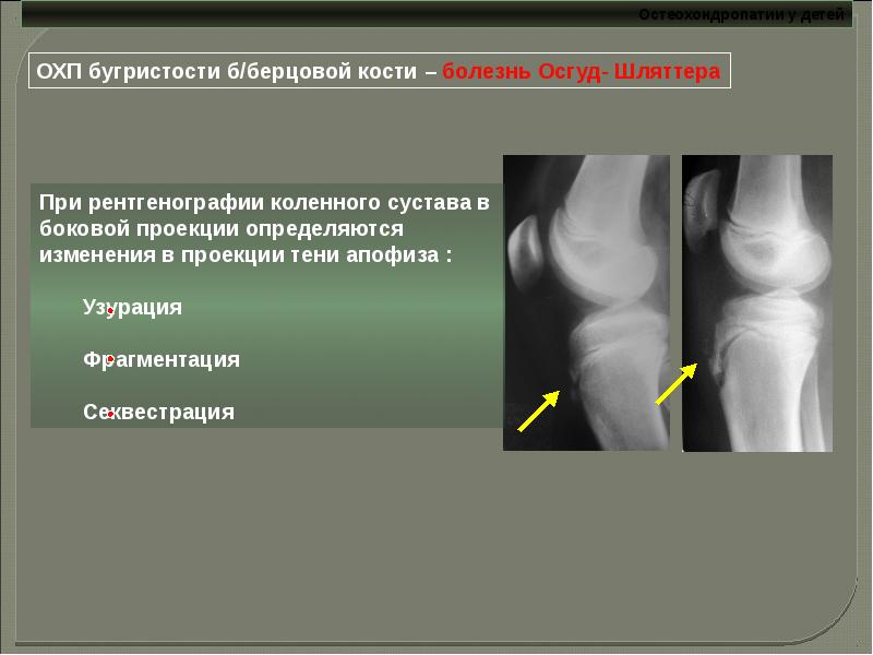 Остеохондропатии у детей презентация