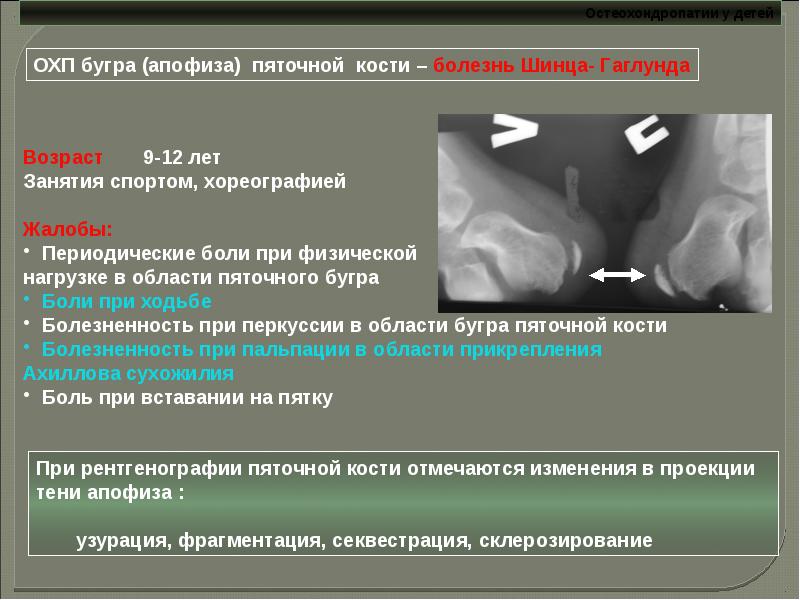 Остеохондропатии у детей презентация