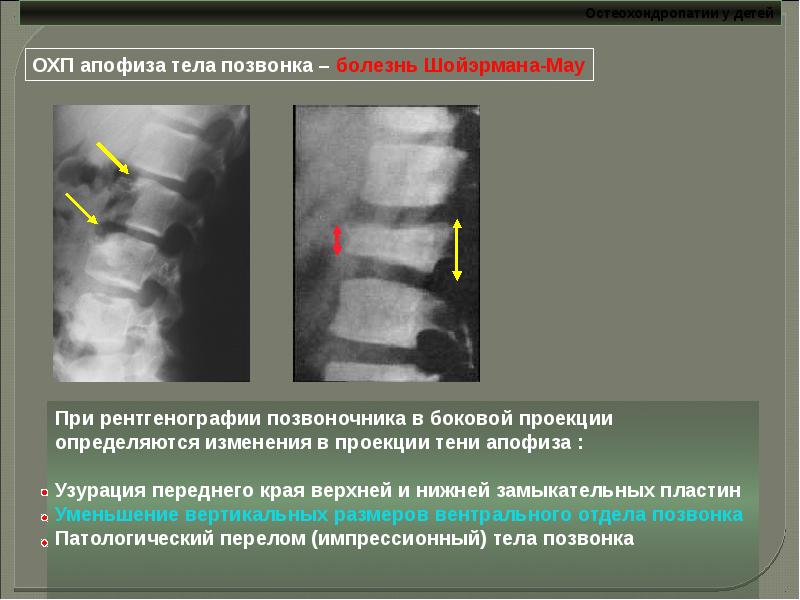 Остеохондропатии у детей презентация