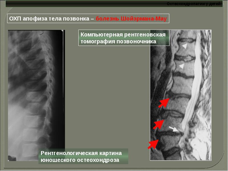 Остеохондропатии у детей презентация