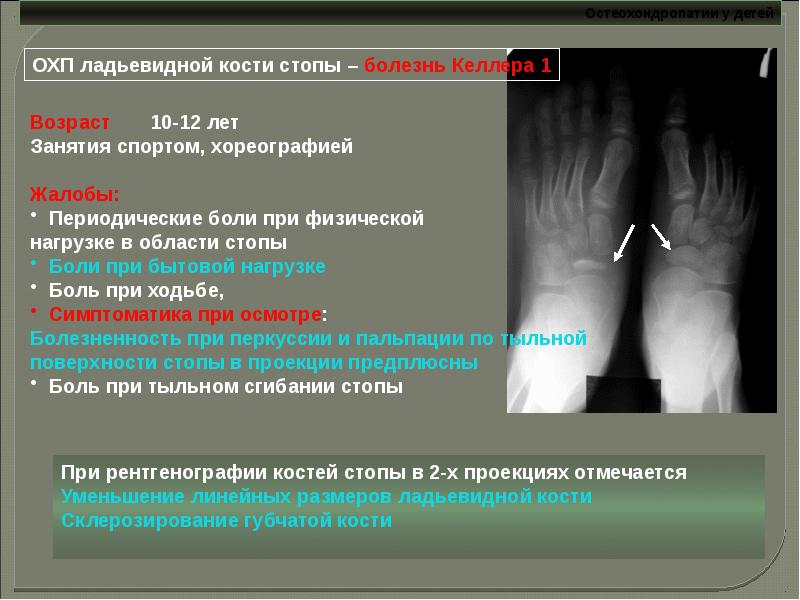 Остеохондропатии у детей презентация