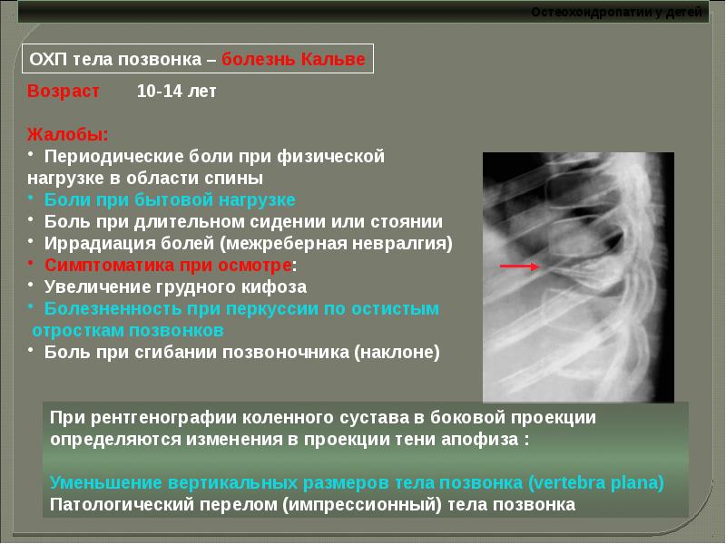 Остеохондропатии у детей презентация