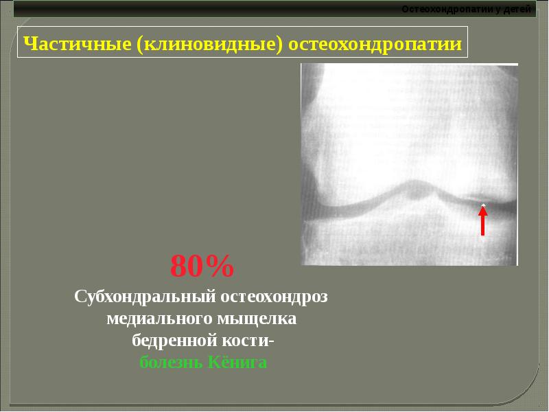 Остеохондропатии у детей презентация