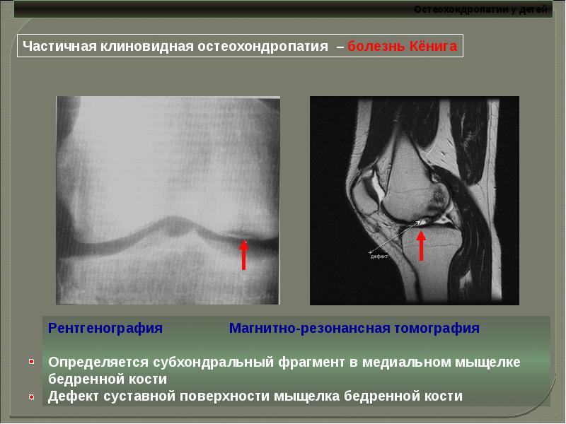 Болезнь кенига презентация