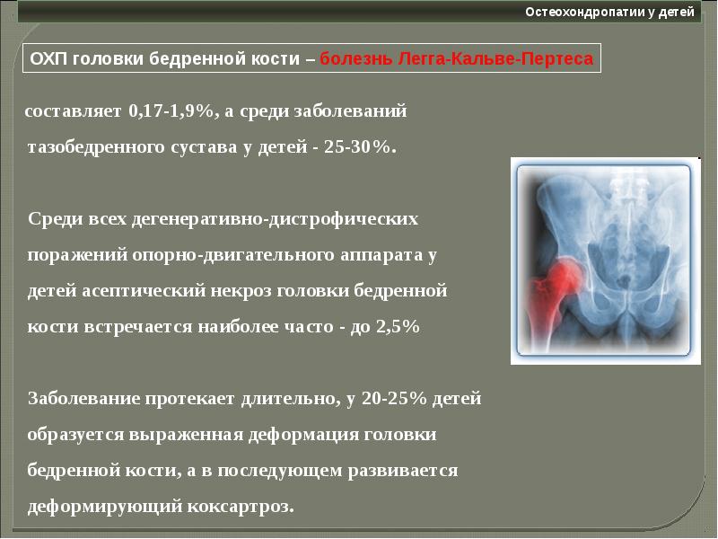 Остеохондропатии у детей презентация