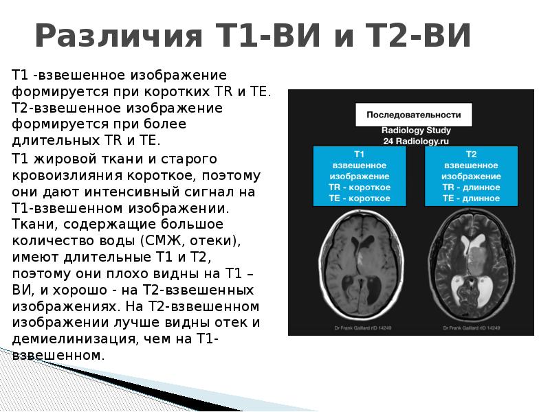 Т1 взвешенное изображение мрт