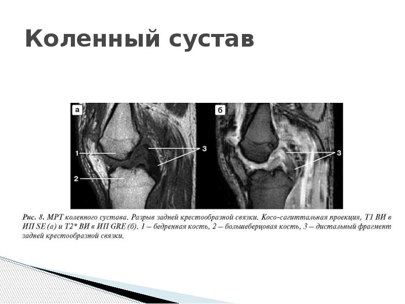 Мрт коленного сустава картинки