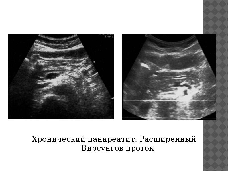 Узи поджелудочной железы как делают у мужчин фото