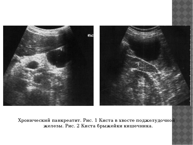 Узи картина хронического панкреатита