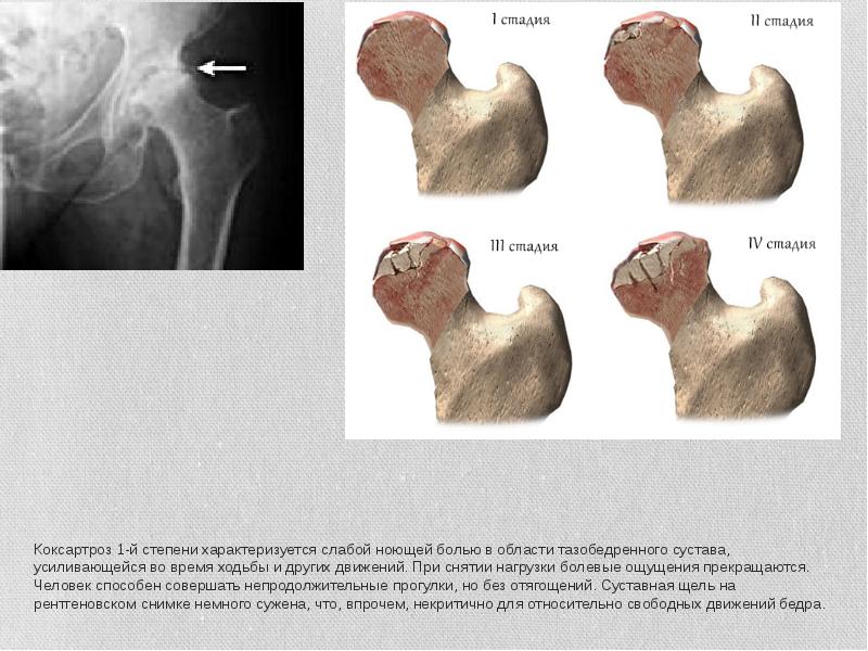 Коксартроз 1-й степени характеризуется слабой ноющей болью в области тазобедренного сустава, Коксартроз 1-й степени характеризуется слабой ноющей болью в области тазобедренного сустава,
