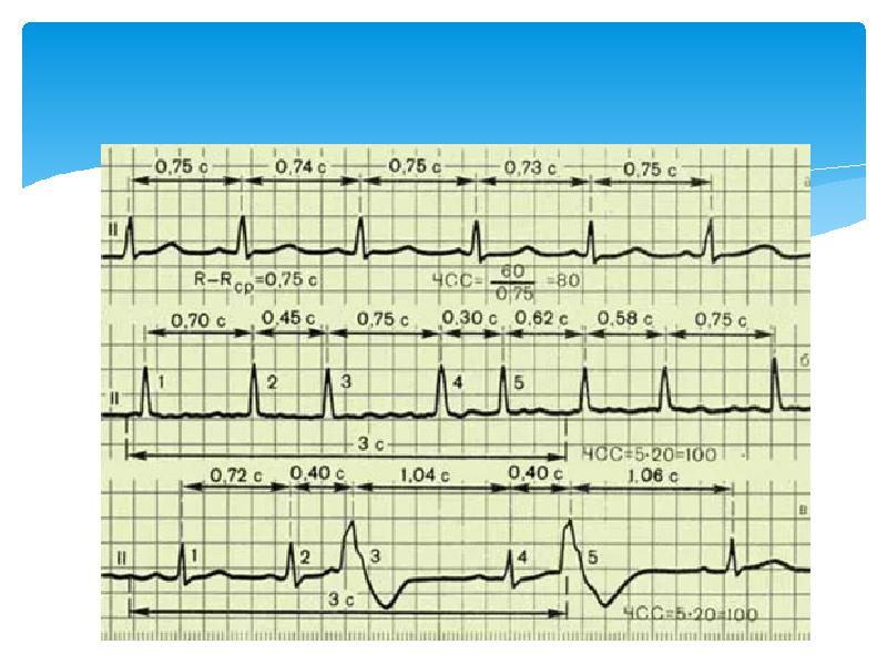 Чсс по экг. Подсчёт ЧСС по ЭКГ 50 мм. Расшифровка ЭКГ показатели ЧСС. Оценка регулярности сердечного ритма ЧСС. Расшифровка ЭКГ 50 мм/с.
