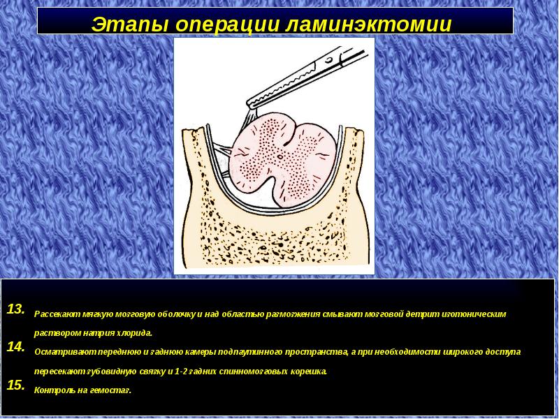 Спинномозговые грыжи презентация