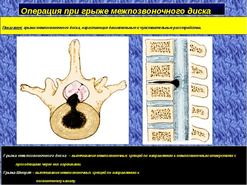 Грыжа межпозвонковых дисков презентация