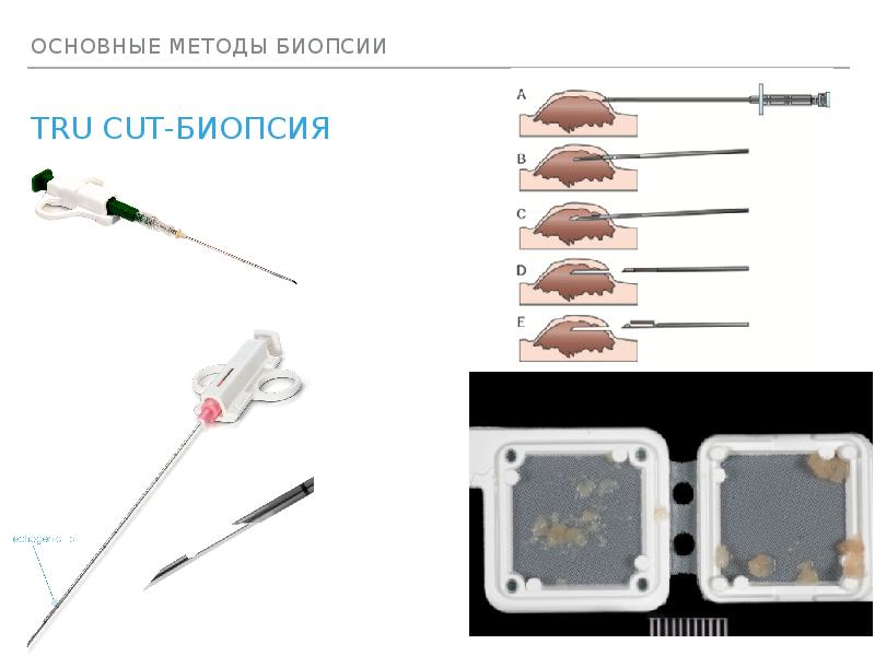 Где можно сделать биопсию. Tru Cut биопсия. Методы оптической биопсии.