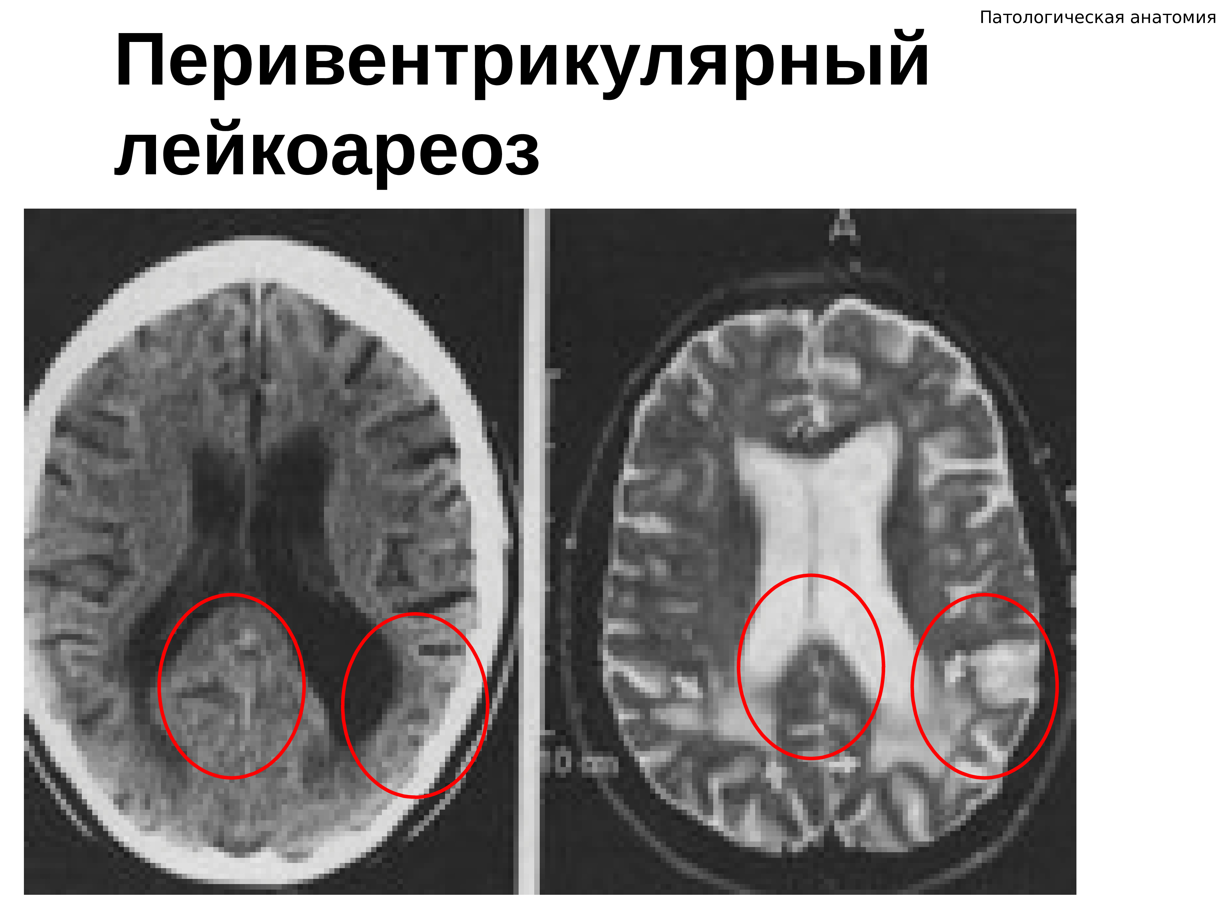 Лейкоареоз головного мозга. Перивентрикулярное снижение плотности вещества головного мозга. Зоны лейкоареоза мрт. Перивентрикулярный Шапочный лейкоареоз. Лейкоареоз в лобных долях.