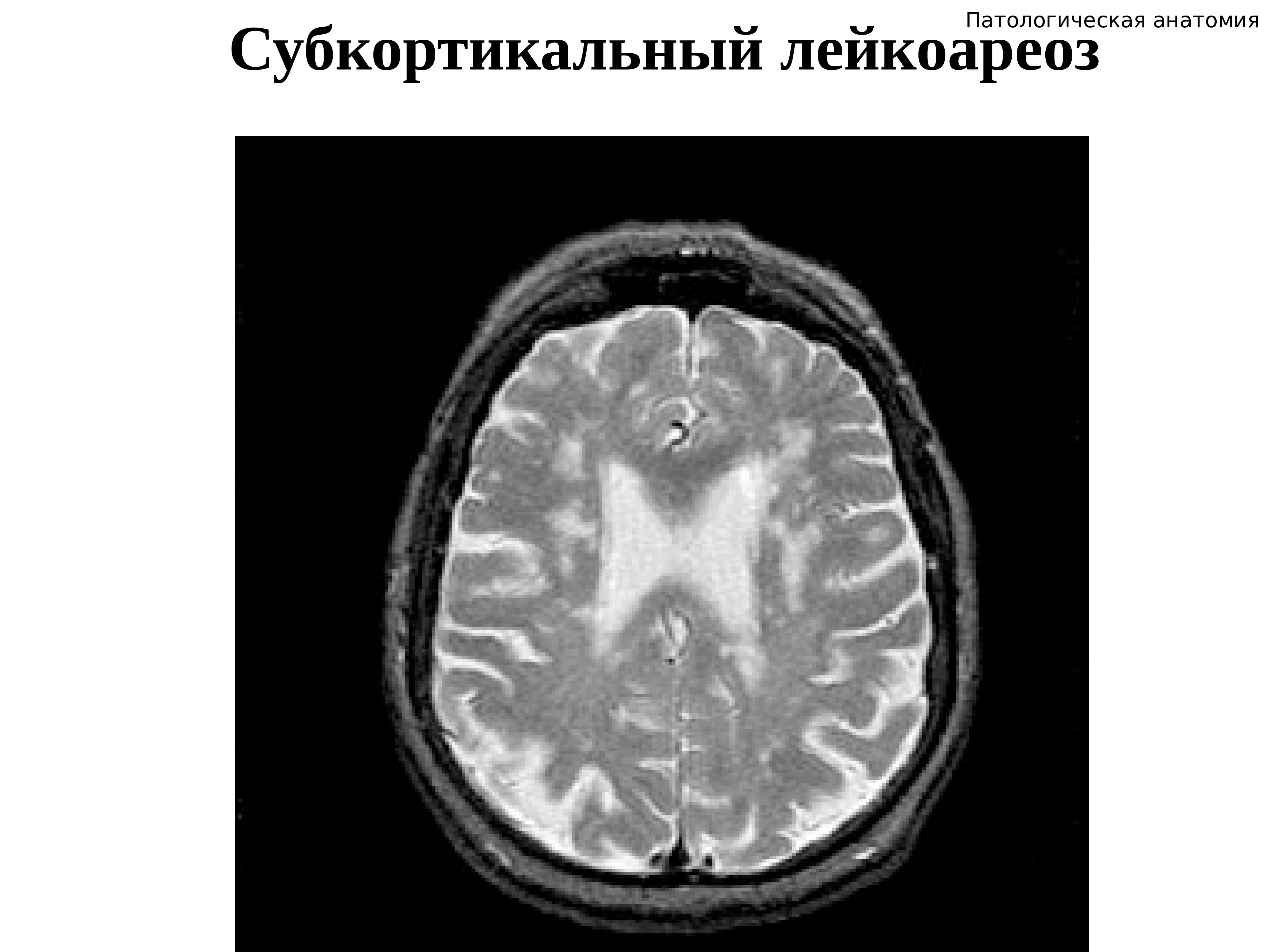 Лейкоареоз головного. Лейкоареоз деменция. Перивентрикулярный лейкоареоз головного мозга на кт. Перивентрикулярный лейкоареоз мрт. Субкортикальный лейкоареоз.