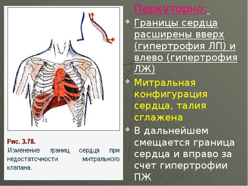 Острая ревматическая лихорадка у детей картинки