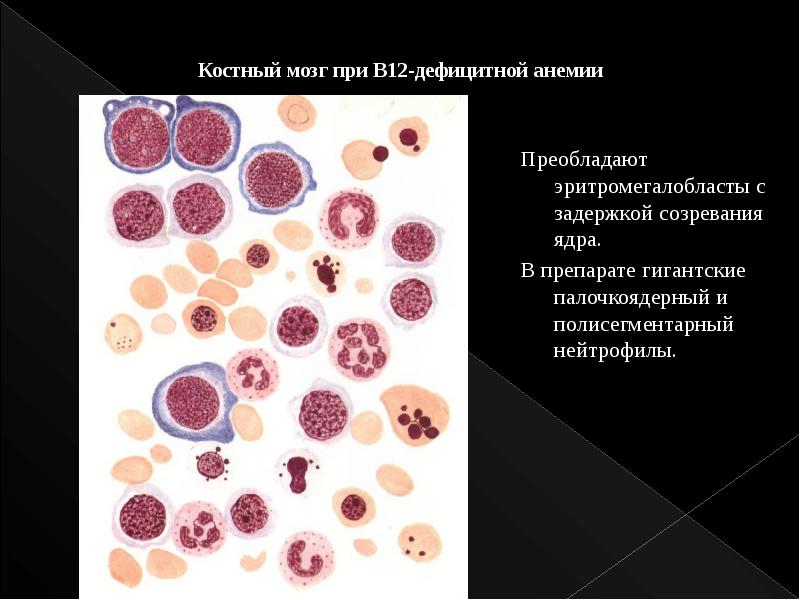 Анемия в12 дефицитная анемия презентация