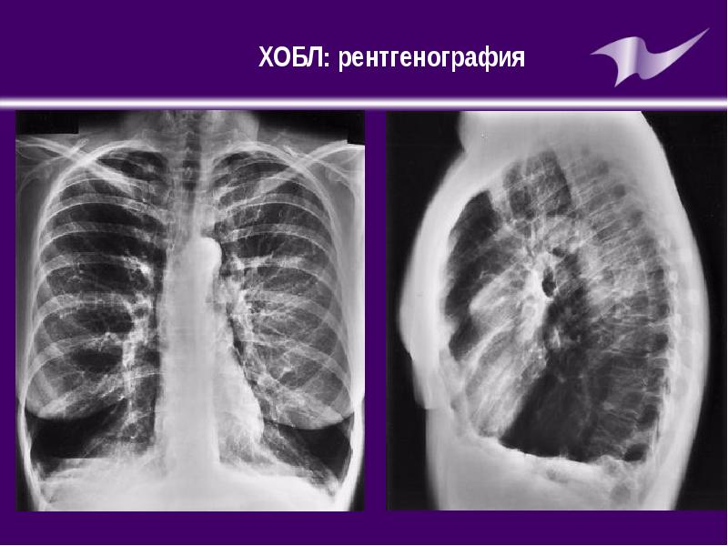 Обструкция легких. Рентген при ХОБЛ эмфизема.