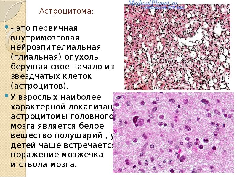 Опухоли наружной локализации презентация