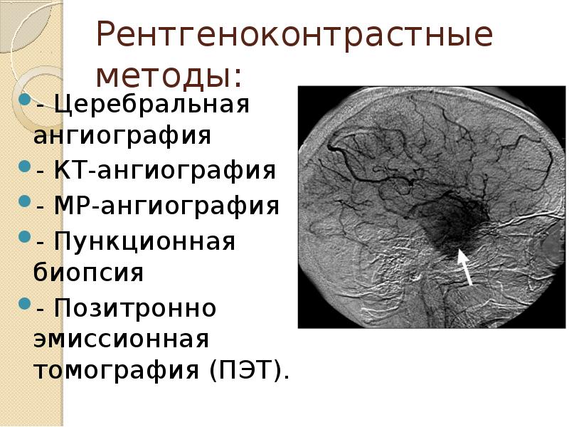 Опухоль головного мозга презентация