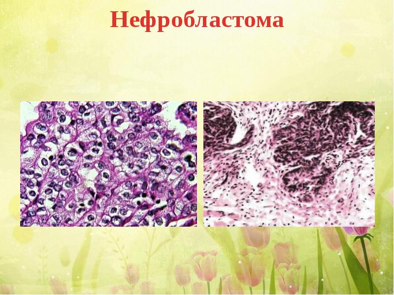 Нефробластома. Нефробластома микропрепарат. Нефробластома гистология. Нефробластома рецидив. Нефробластома препарат.