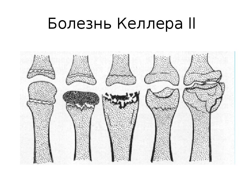 Болезнь кинбека презентация