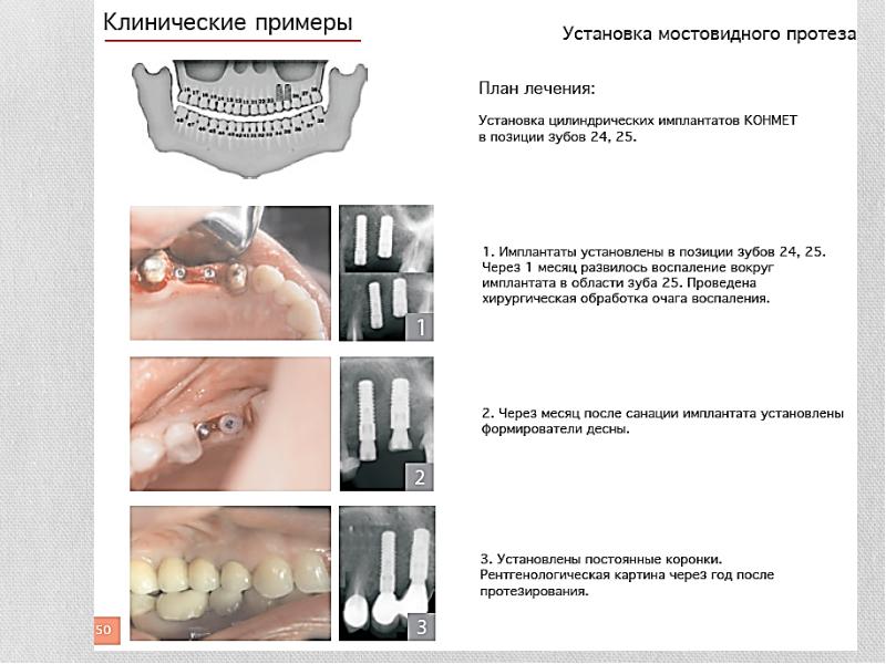 Хирургический инструментарий и медикаментозное сопровождение дентальной имплантации презентация