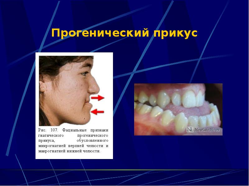 Мезиальный прикус. Прогения прогенический прикус. Строение челюсти прогения прогнатия норма. Мезиальный прикус прогения.