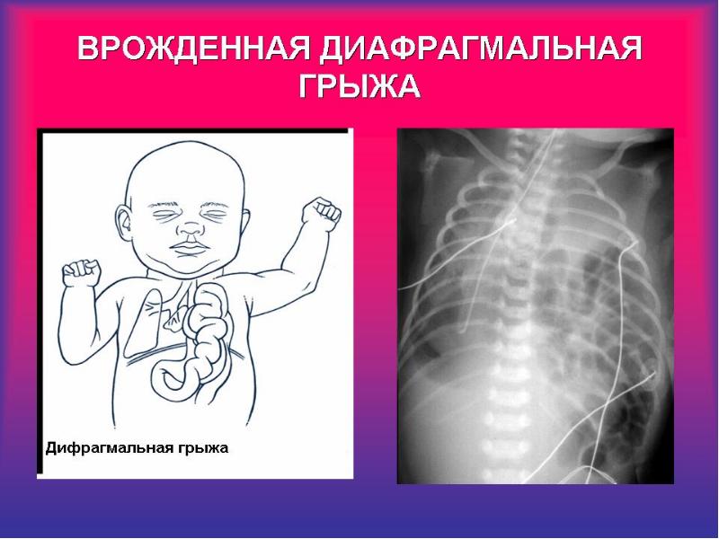 Гипоксия плода асфиксия новорожденного презентация