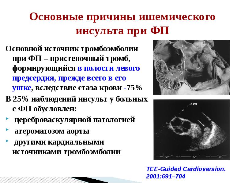 Тромбоэмболии инсульта. Тромбоз левого предсердия. Причины ишемического инсульта. Тромб в ушке левого предсердия. Тромбоз левого предсердия причины.