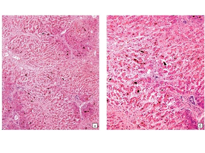 Токсическая печень. Некроз печени макропрепарат. Токсическая дистрофия печени патанатомия. Дистрофия печени макропрепарат. Центролобулярные некрозы печени гистология.