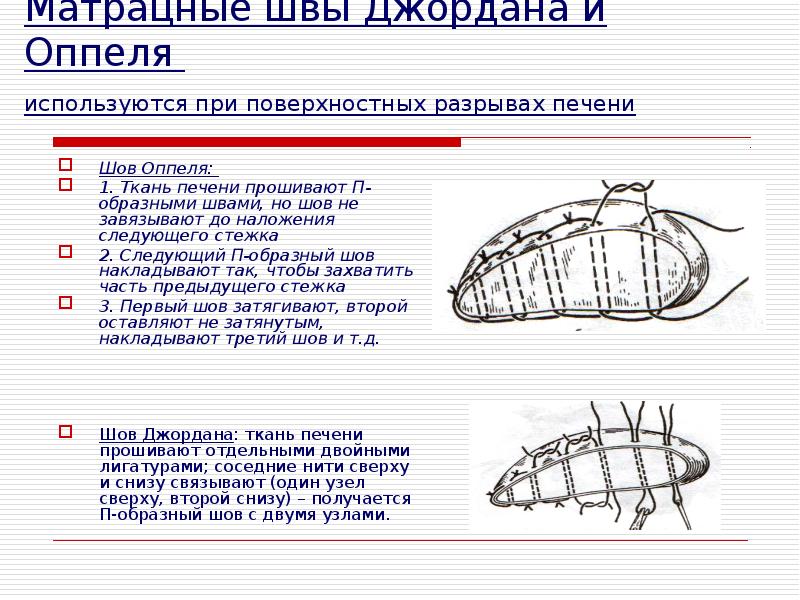 Непрерывный матрацный шов на кожу. Surgical sutures on the … Foto 16