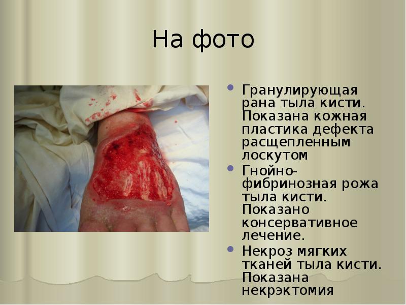 На фото
Гранулирующая рана тыла кисти. Показана кожная пластика дефекта расщепленным На фото
Гранулирующая рана тыла кисти. Показана кожная пластика дефекта расщепленным