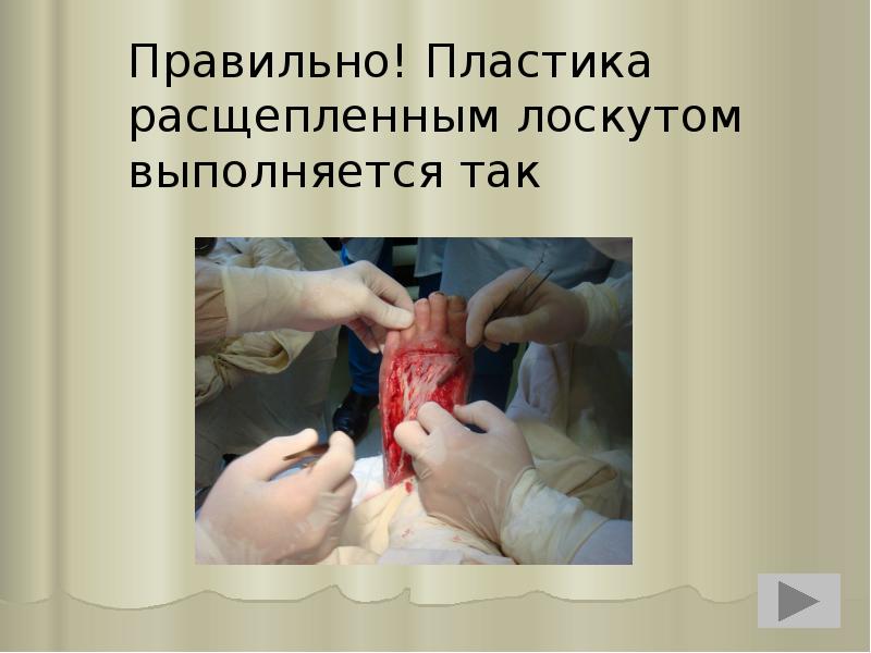 Правильно! Пластика расщепленным лоскутом выполняется так Правильно! Пластика расщепленным лоскутом выполняется так