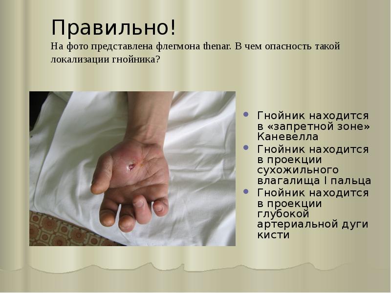 Правильно! На фото представлена флегмона thenar. В чем опасность такой локализации Правильно! На фото представлена флегмона thenar. В чем опасность такой локализации
