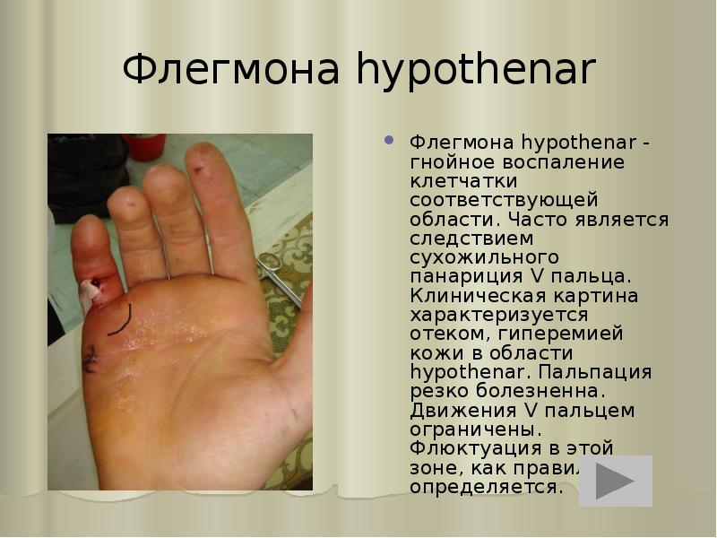 Флегмона hypothenar
Флегмона hypothenar - гнойное воспаление клетчатки соответствующей области. Часто Флегмона hypothenar
Флегмона hypothenar - гнойное воспаление клетчатки соответствующей области. Часто