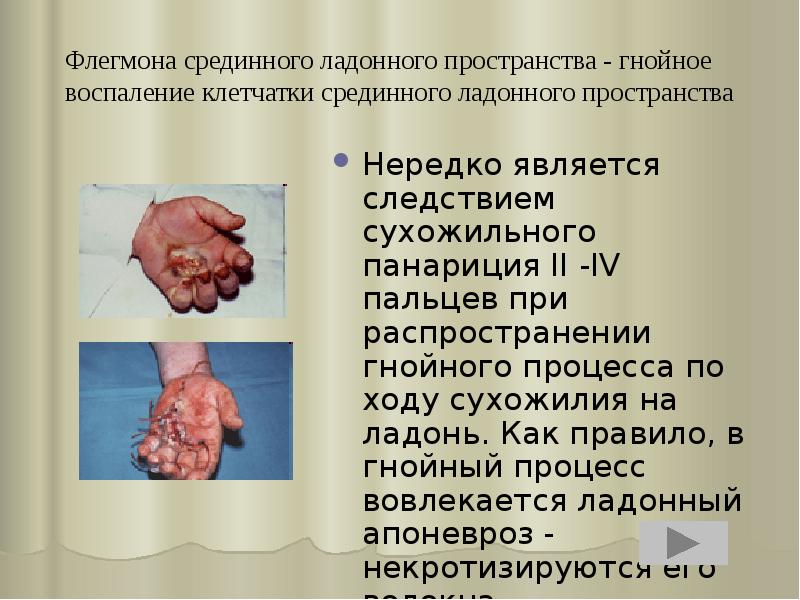 Флегмона срединного ладонного пространства - гнойное воспаление клетчатки срединного ладонного пространства
Флегмона срединного ладонного пространства - гнойное воспаление клетчатки срединного ладонного пространства