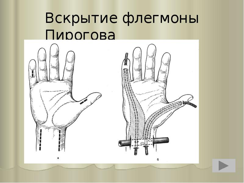 Вскрытие флегмоны Пирогова Вскрытие флегмоны Пирогова