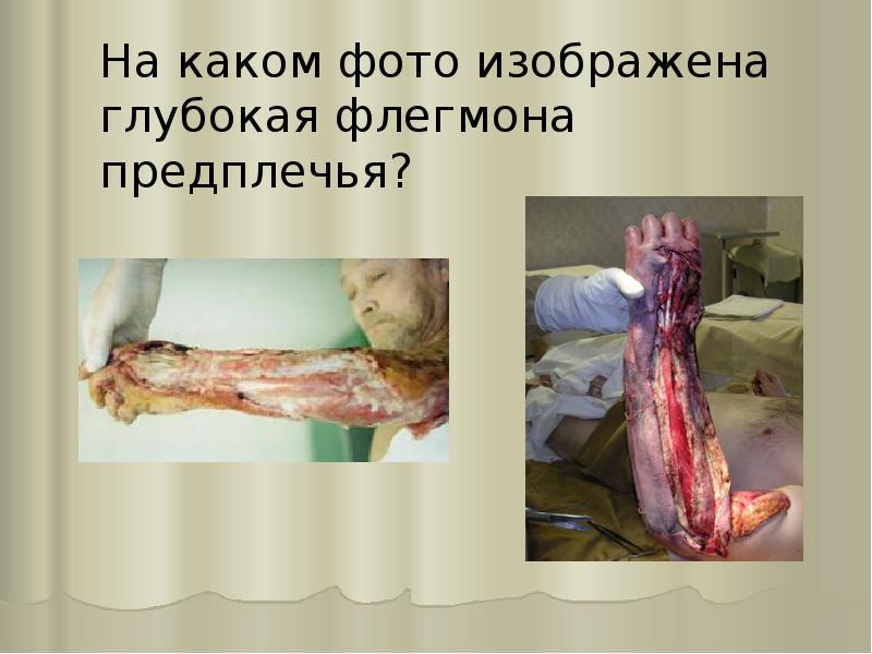 На каком фото изображена глубокая флегмона предплечья? На каком фото изображена глубокая флегмона предплечья?